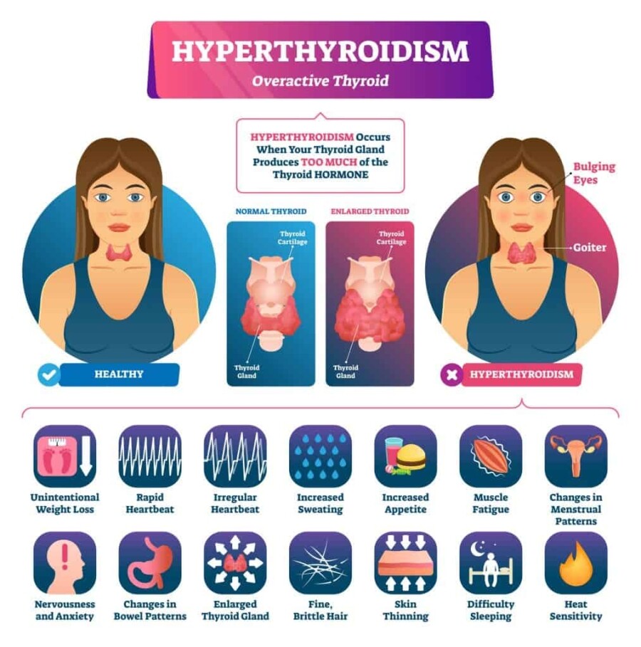 Image showing the symptoms of hyperthyroidism. Many symptoms show up over time with hyperthyroidism.
